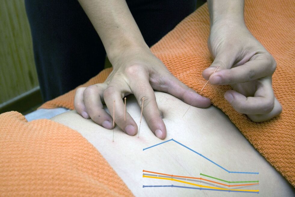 Akupunktur er fortsatt den mest populære alternative behandlingsformen i det utvalget vi har tatt med.
 Foto: Pixabay