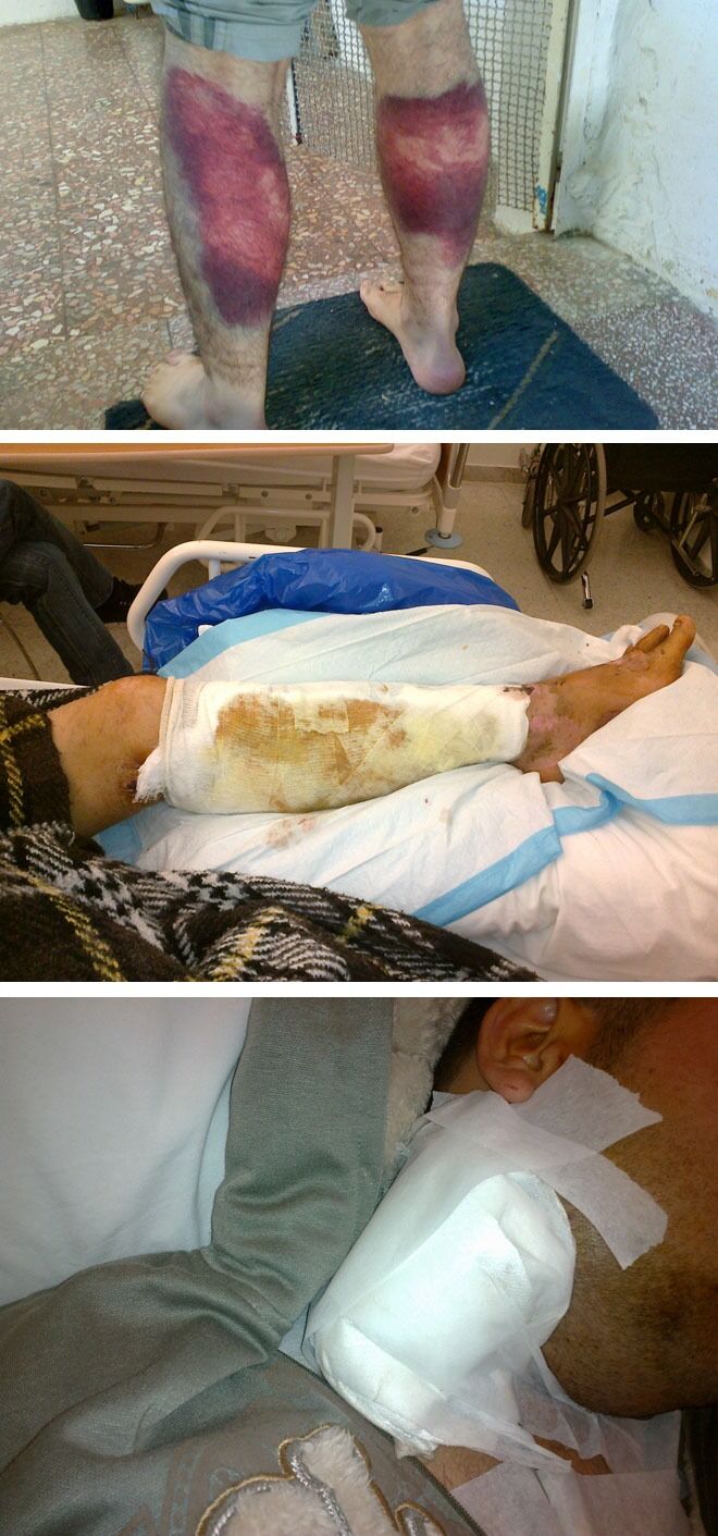 Noen av skadene Mohammad har fått etter tortur i syrisk fengsel. Han ønsker å være anonym.
 Foto: Privat
