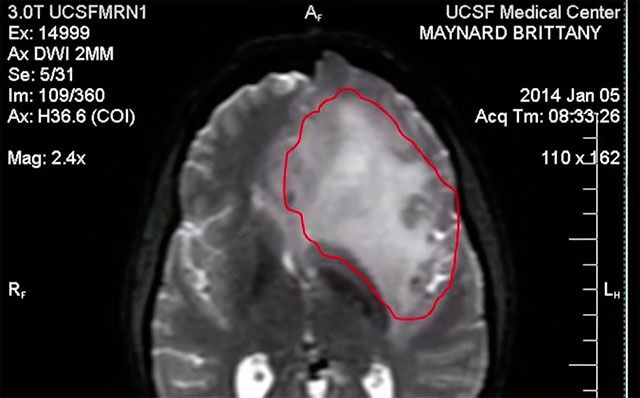 Offentliggjort røntgenbilde av Brittany Maynards hjernesvulst i januar 2014. Overlege Morten Horn får det ikke til å stemme at hun med en så stor svulst i hodet ikke hadde noe språklig, mentalt eller fysisk funksjonstap nesten elleve måneder senere.