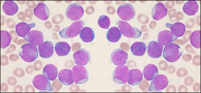 Slik ser Akutt lymfoblastisk leukemi ut. Hib-vaksinen hinder slike blodkreftceller i å utvikle seg.